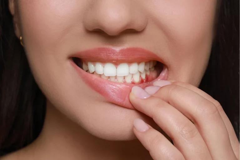 Gum-Disease-Awareness-Protect-Your-Smile-This-Winter