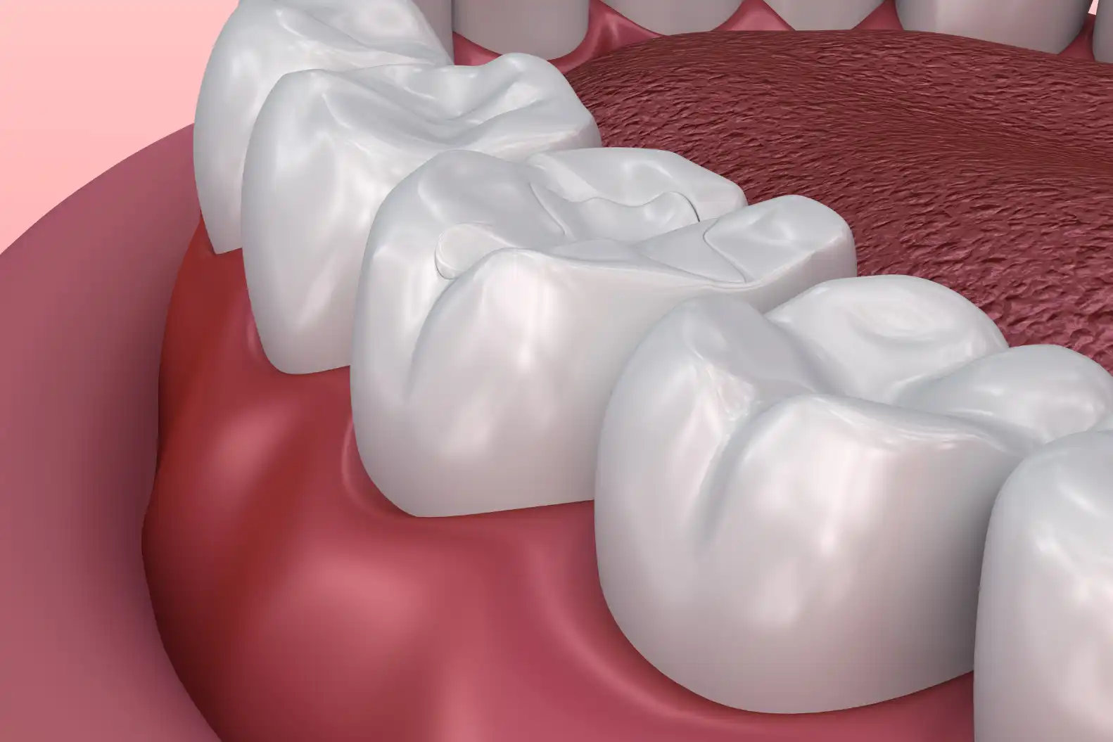 Dental-Sealants