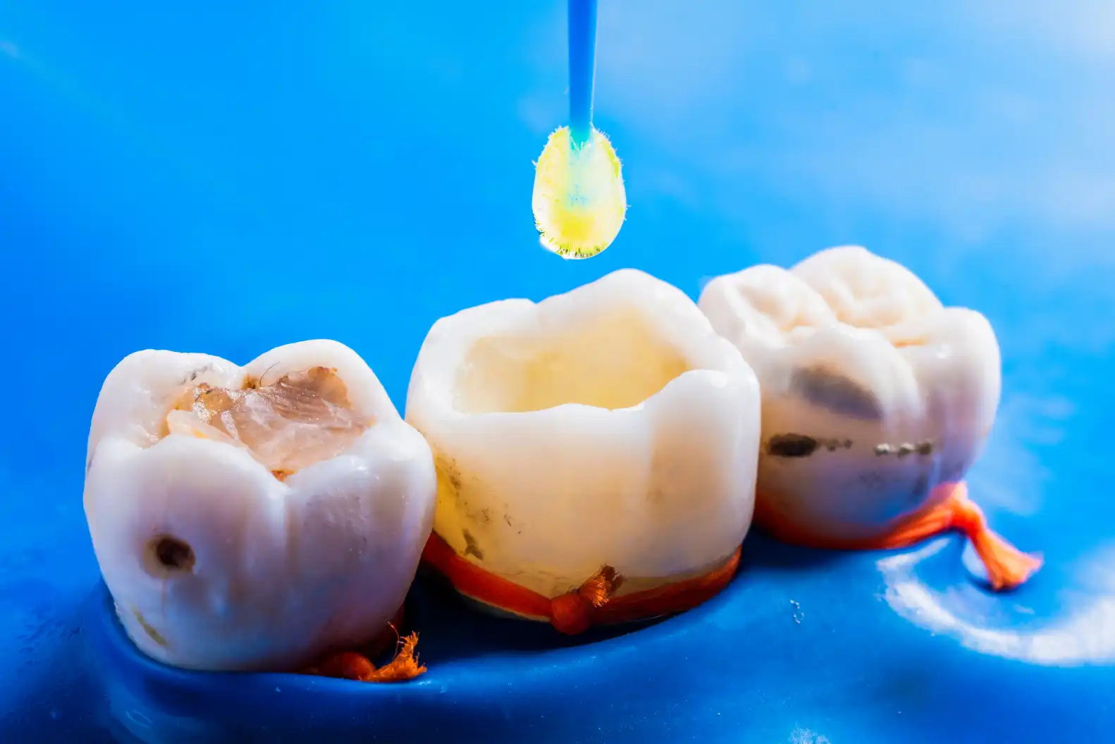 Fillings-1