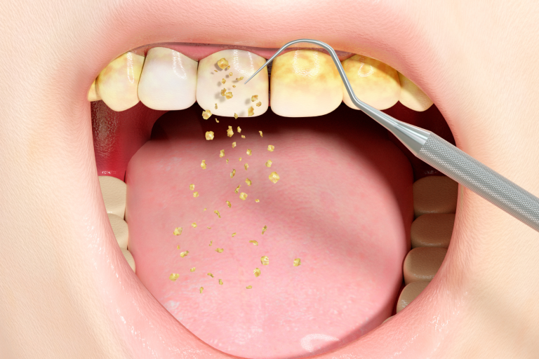 dental plaque