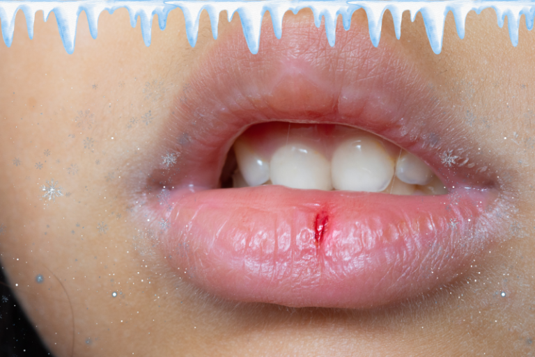 cold-weather-and-dry-mouth-what-you-should-know