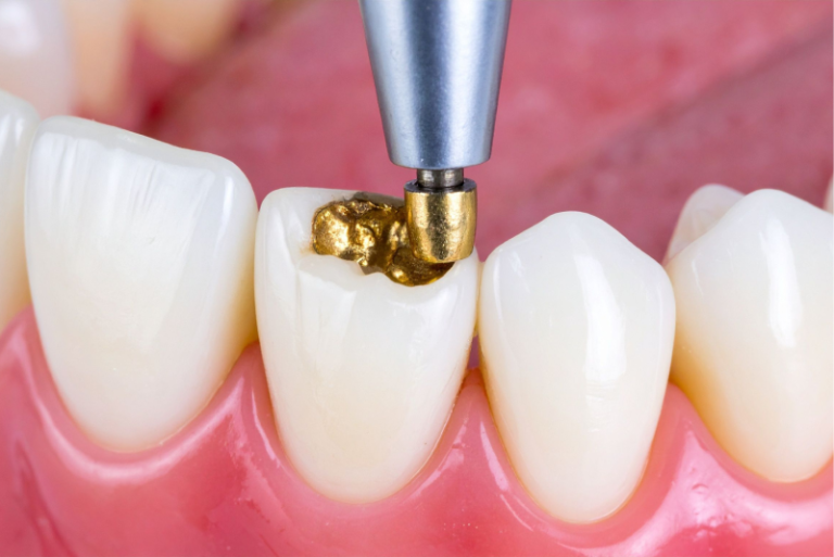 dental-fillings-explained-when-and-why-you-might-need-one