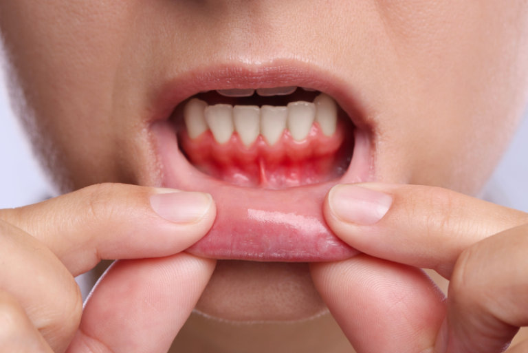 gum-health-in-the-new-year-preventing-gum-disease-before-it-starts