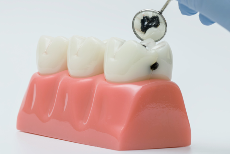 understanding-tooth-decay-how-cavities-form-and-how-to-prevent-them