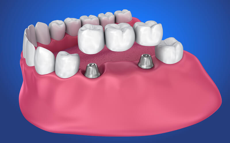 Dental Bridges Langley Dental - Dental Implant support