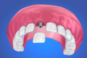 Dental Implants Langley Dental