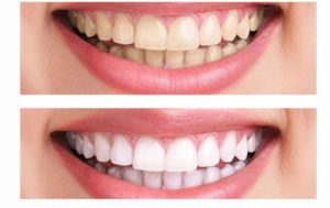 Langley Dental Centre Teeth Cleaning
