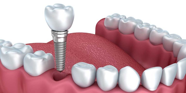 Single-Dental-Implant