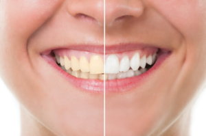 Teeth Whitening Langley Dental