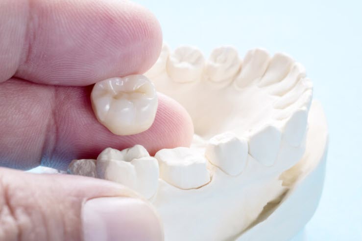 dental crown - dental crowns have many benefits