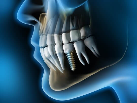 Dental Implant Digital X-Ray of a head with a single dental implant