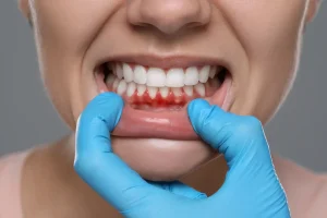 gums
