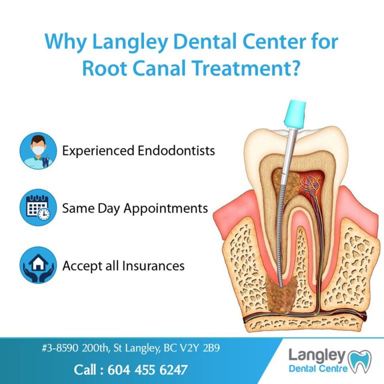 Save Your Teeth With Root Canal Treatment - Langley Dental Centre