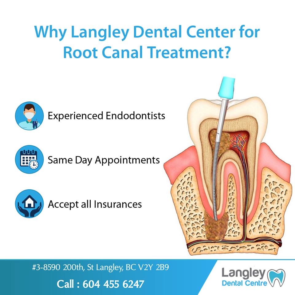 Why choose Root Canal Treatment