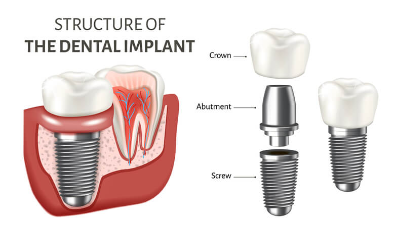 Dental Implant diagram Structure